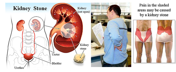 Kidney stones